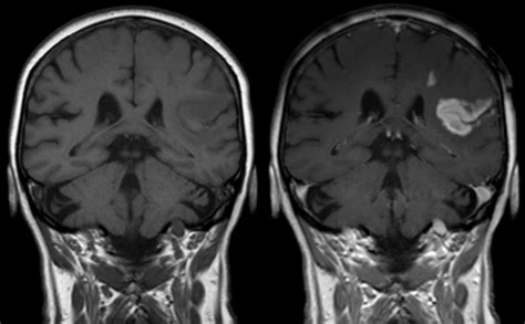 CVA / Stroke / TIA (Cerebrovascular Accident) - Regional Rehab