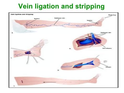 Venous Disorders