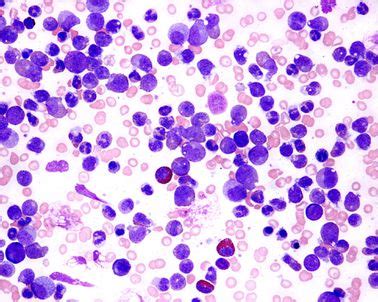 What Is Granulocytosis and When Does It Occur?