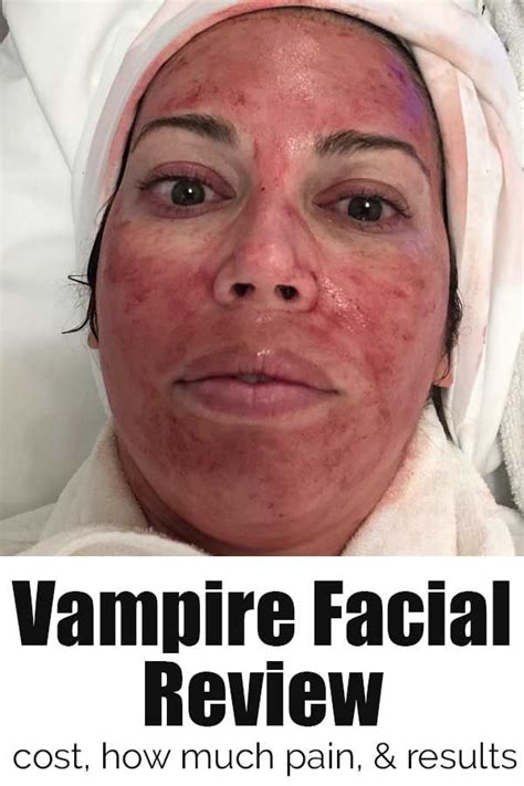 Vampire Facial Review: PRP Facial | The Happier Homemaker | Vampire ...