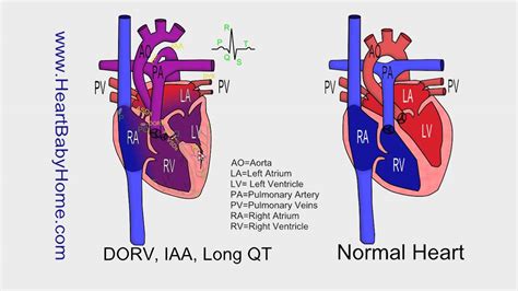 65 - DORV, interrupted Aortic Arch, Long QT, William's Syndrome - YouTube