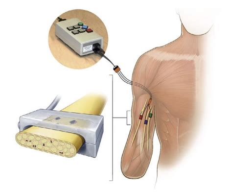 Implanted Peripheral Nerve Ele [IMAGE] | EurekAlert! Science News Releases