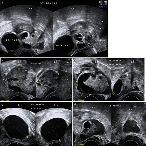 Ultrasound Evaluation of Adnexal Pathology | Obgyn Key