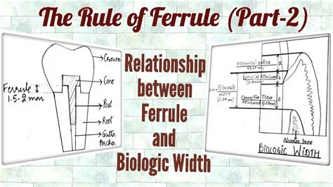 Ferrule Effect (Part-2)/ Relationship between Ferrule and Biologic ...