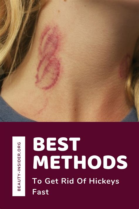 Best Methods To Get Rid Of Hickeys Fast in 2020 | Hickeys, How to get rid, Get rid of hickies