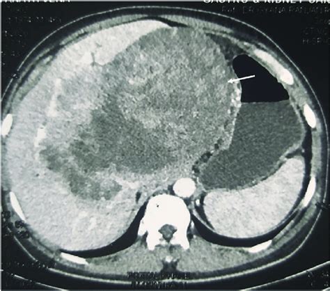 Triphasic computed tomography angiography revealed a heterodense ...