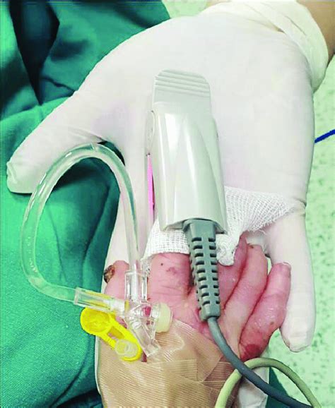 Placement of the pulse oxymetry probe. | Download Scientific Diagram