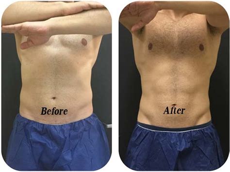 CoolSculpting For Men To Tackle Stubborn Fat