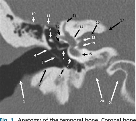 Fig. 1. Anatomy of the temporal bone. Coronal bone algorithm computed ...