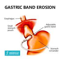 Gastric Banding (Lap-Band) Surgery Risks, Complications