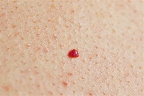 Cherry Angioma: Causes, Pictures, Treatment & Prevention