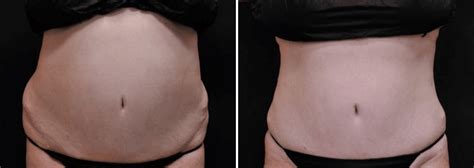 What Are Dog Ears After Tummy Tuck