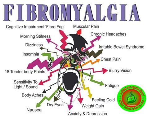 Fibromyalgia, Causes, Symptoms, Diagnosis, Treatment - Rxharun