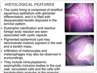 Globulomaxillary Cyst Histology