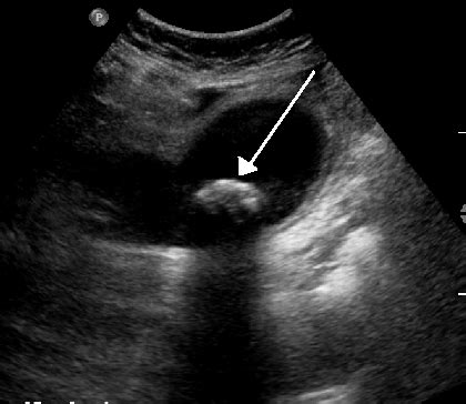 Biliary colic - Wikiwand