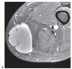 Angiolipoma. Ultrasound image shows well-defined hyperechoic ...