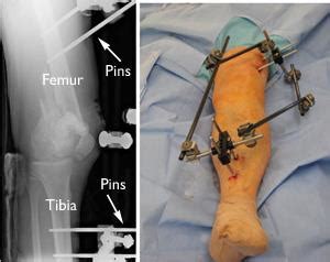 Distal Femur (Thighbone) Fractures of the Knee - OrthoInfo - AAOS