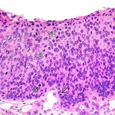 Erythroplasia Of Queyrat Histology