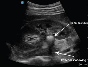 Renal colic – the twinkle artifact – Critical Care Sonography