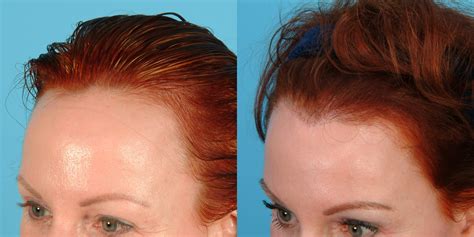 Female Hairline Lowering · Bauman Medical Group