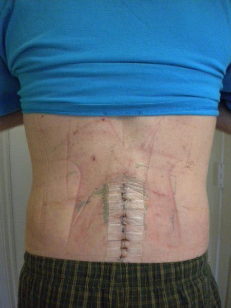 Photo of Spinal Fusion Incision – L4 & L5 | God has your back!