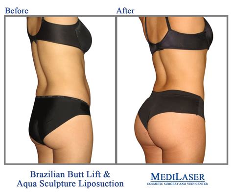 Before and After Pictures of Brazilian Butt Lift | Brazilian Butt Lift ...