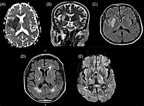 MRI-brain views (coronal and axial) of Case 5 with Parkinsonism. They ...