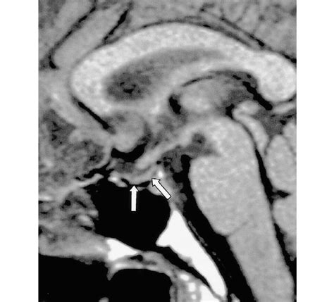 Transection of the pituitary stalk caused by a fall in a 17year-old ...