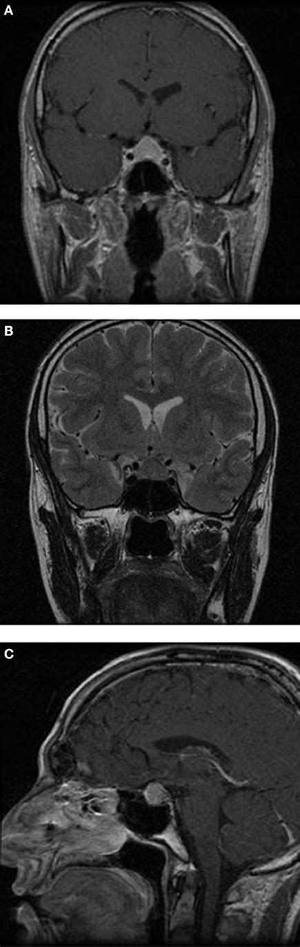 Frontiers | Hypophysitis following Treatment with Ustekinumab: Radiological and Pathological ...