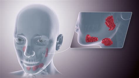 Salivary Gland Disorders - StoryMD