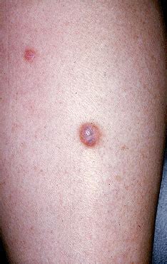 Seborrheic Keratosis - Clear Cell Acanthoma | Dr. Perri