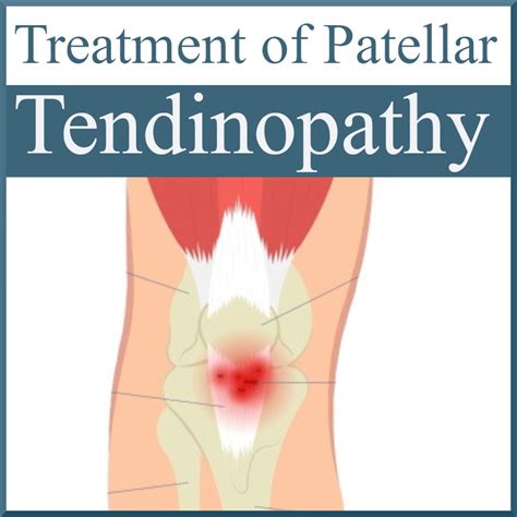 Treatment of Patellar Tendinopathy - Sports Medicine Review