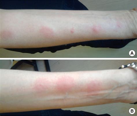 (A) Flare up reaction at the sites where intradermal tests to GA had... | Download Scientific ...