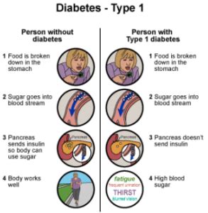 Diabetes in Kids Type 1 – BMC