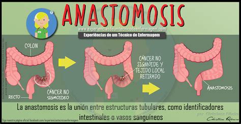 La Anastomosis | Enfermagem Ilustrada