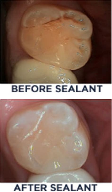 Dental Sealants - Virginia Family DentalVirginia Family Dental