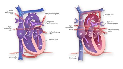 TAPVC: Causes, Surgery, Symptoms and Recovery