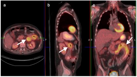 Pet Scan Colon Cancer