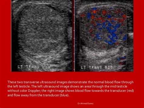 Imaging orchitis epidydmitis epidydmo orchitis DrAhmed Esawy