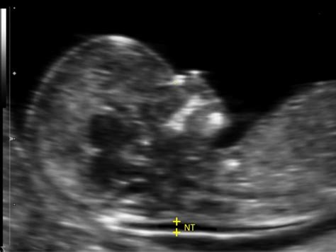 Us Obstetric Nuchal Dating Scan Meaning / Nuchal Scan Ultrasound Scans Welcome To The Fetal ...