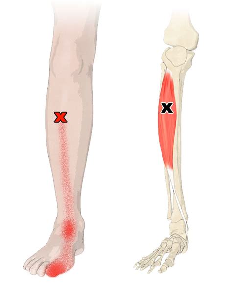 The Tibialis Anterior Muscle | Trigger points, Lower leg muscles, Trigger point therapy