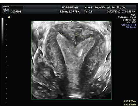 Do Measurements of Uterine Septum Using Three-Dimensional Ultrasound and Magnetic Resonance ...