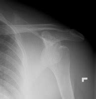 Coracoid Fracture