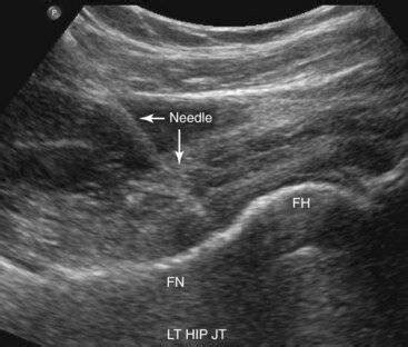 Fluoroscopy vs. Ultrasound for Hip Injections- Sports Medicine Review