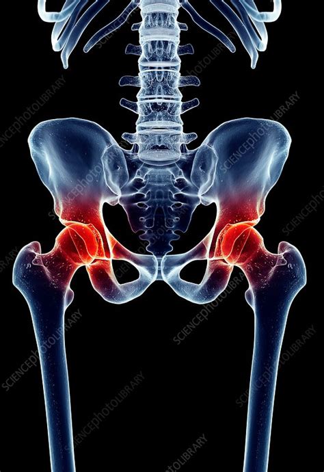 Human hip joint pain - Stock Image - F016/3290 - Science Photo Library