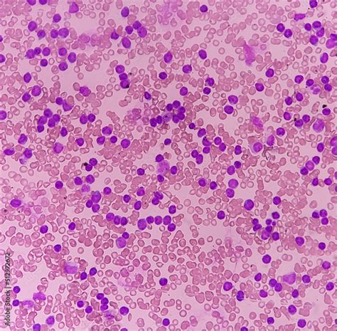 Acute leukemia, peripheral blood smear show most of cell are blast cell with abundant cytoplasm ...