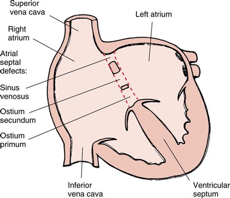 Atrial Septal Defect