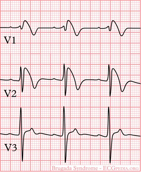 Brugada syndrome electrocardiogram - wikidoc