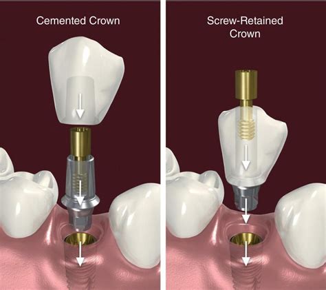 Screw‐Retention vs Cement Retention of Restorations | Pocket Dentistry