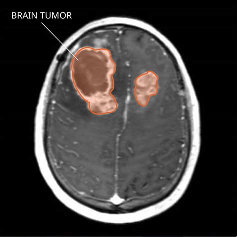 Gliosarcoma: Diagnosis and Treatment - NCI